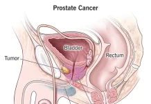 The cancer symptoms men should not ignore